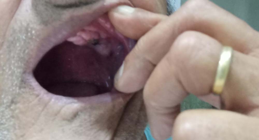 Desdentados de Bernardino de Campos: idoso fala sobre o sofrimento ao ser atraído pela promessa de implantes dentários gratuitos - sudoestepaulista