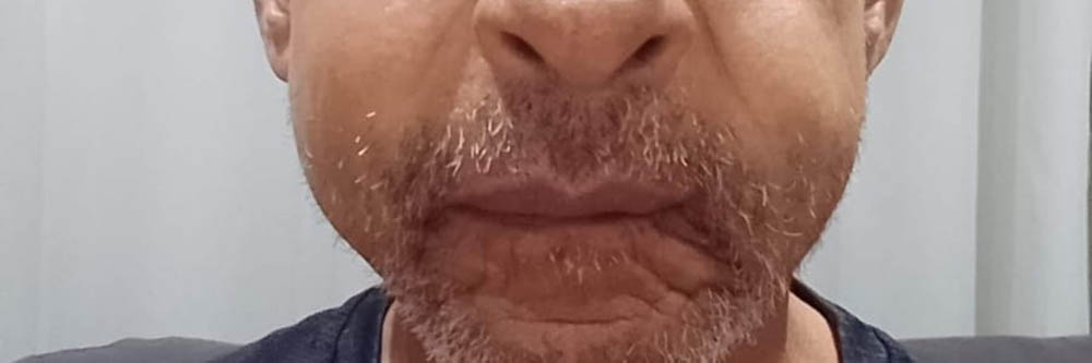 Desdentados de Bernardino de Campos: idoso fala sobre o sofrimento ao ser atraído pela promessa de implantes dentários gratuitos - sudoestepaulista